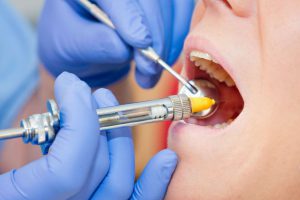 Анестезия в стоматологии