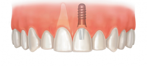 Удаление зубных имплантов